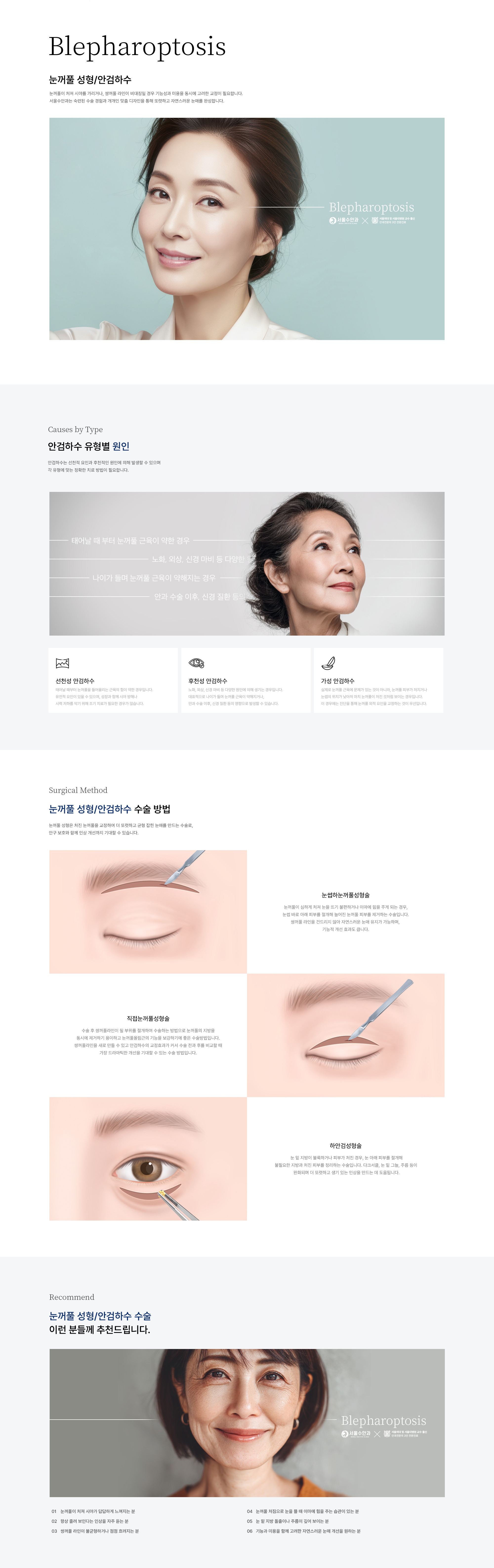 눈꺼풀 성형/안검하수